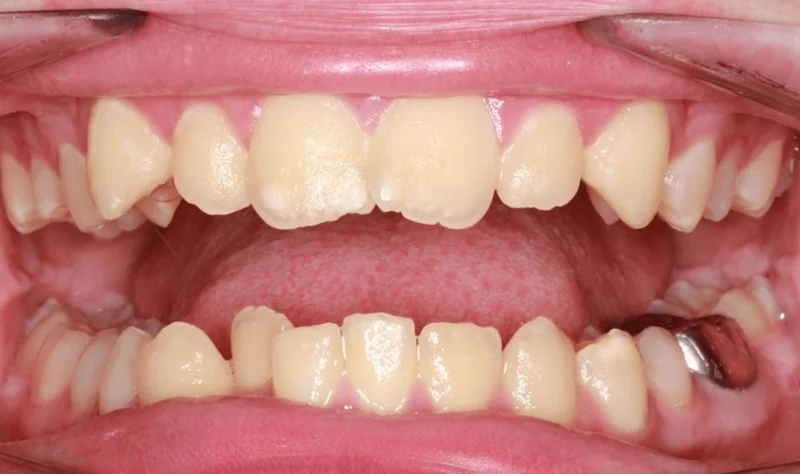 Center Open Smile - Before Treatment