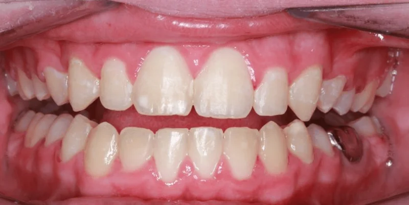 Center Open Smile - After Treatment