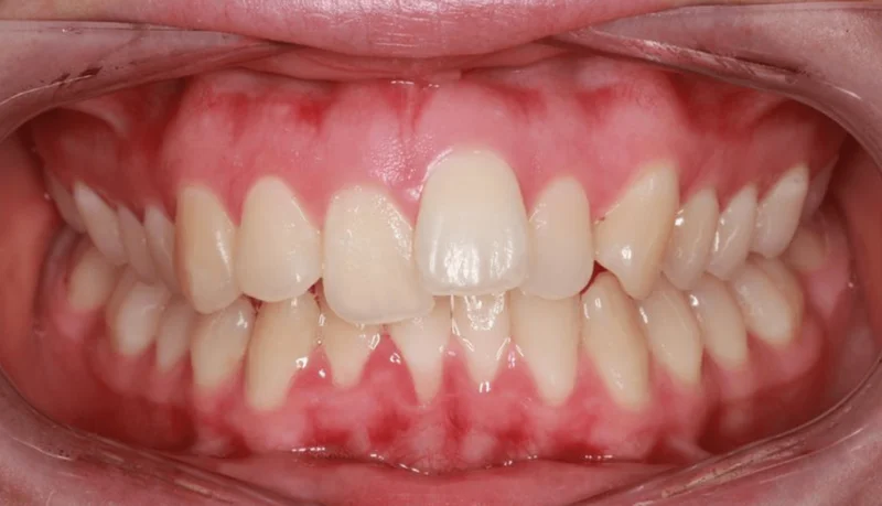 Center Bite - Before Treatment