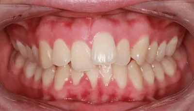 Before Carriere Correction Appliance treatment - Case 59837