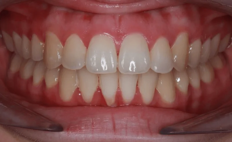 Center Bite - After Treatment