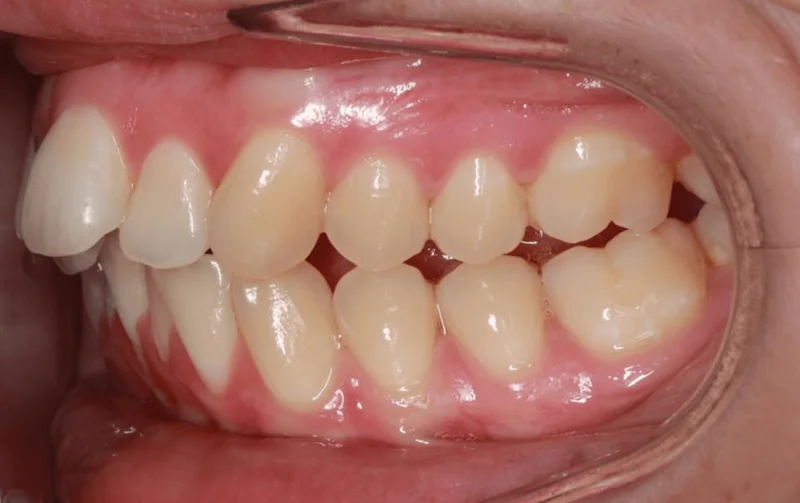 Left Bite - Before Treatment