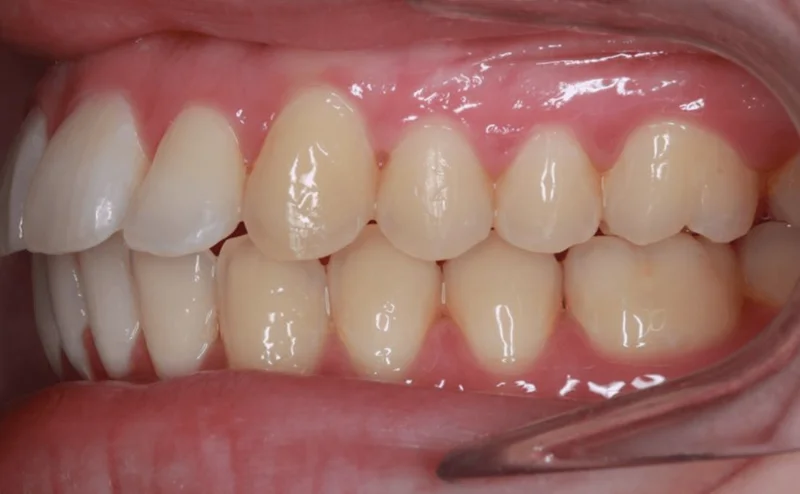 Left Bite - After Treatment