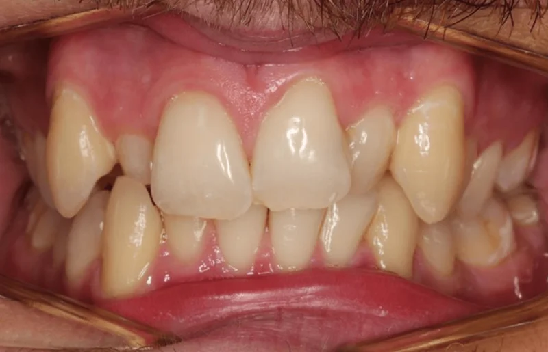 Center Bite - Before Treatment