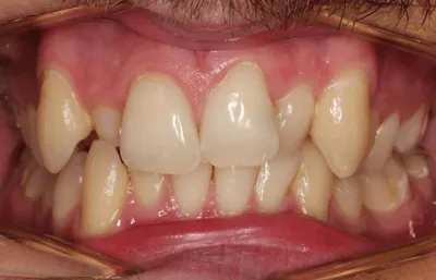 Before Metal Braces treatment - Case 64535
