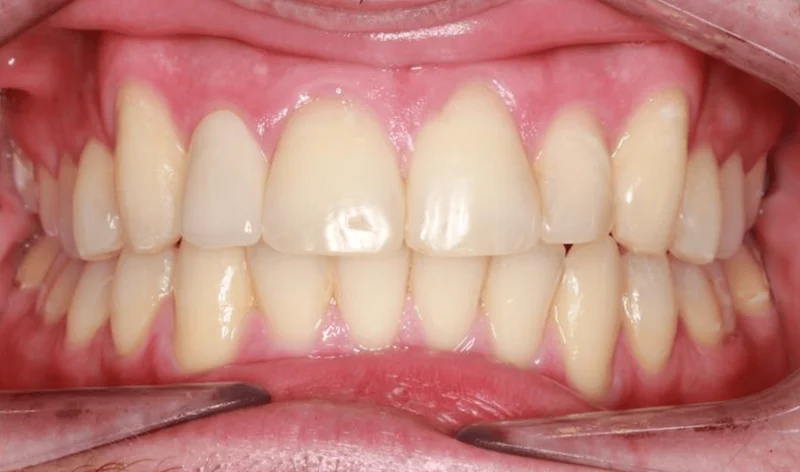 Center Bite - After Treatment