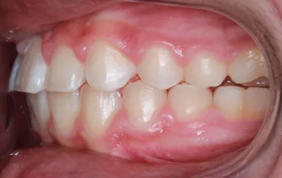 After Metal Braces treatment - Case 42723
