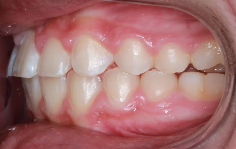 Left Buccal View - After Treatment