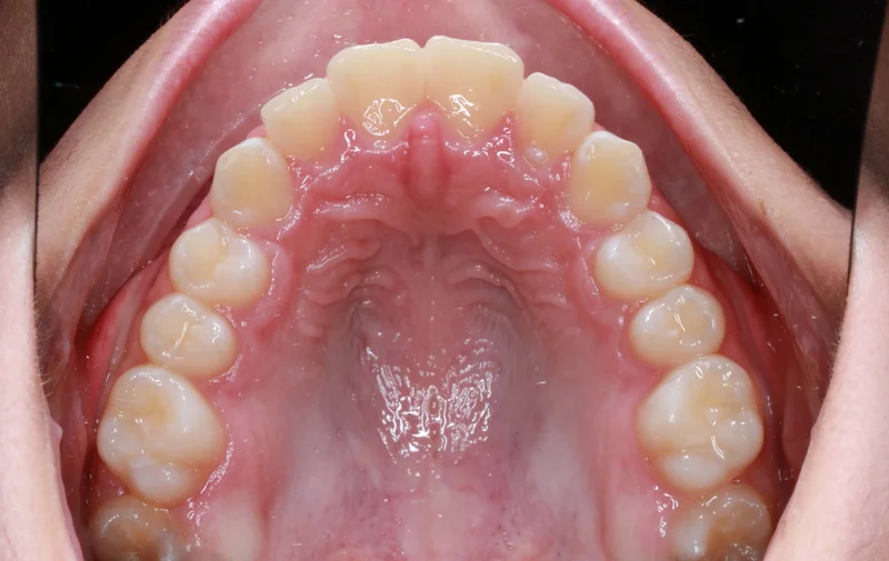Upper Occlusal View - After Treatment