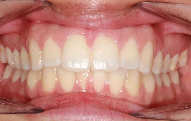 Center - Before Treatment