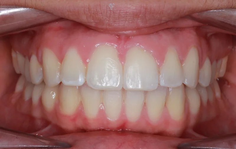 Center - After Treatment