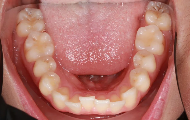 Lower - Before Treatment