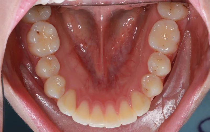 Lower - After Treatment