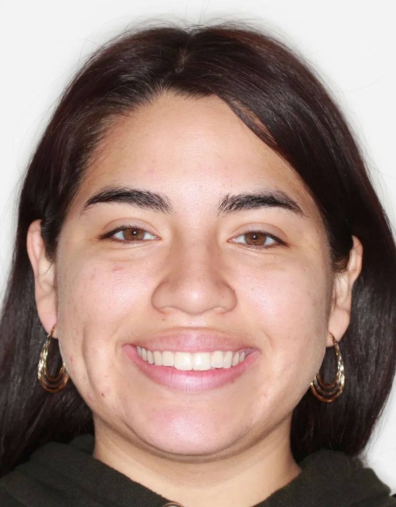 Smiling - Before Treatment