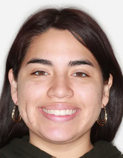 Before Clear Braces treatment - Case 52581