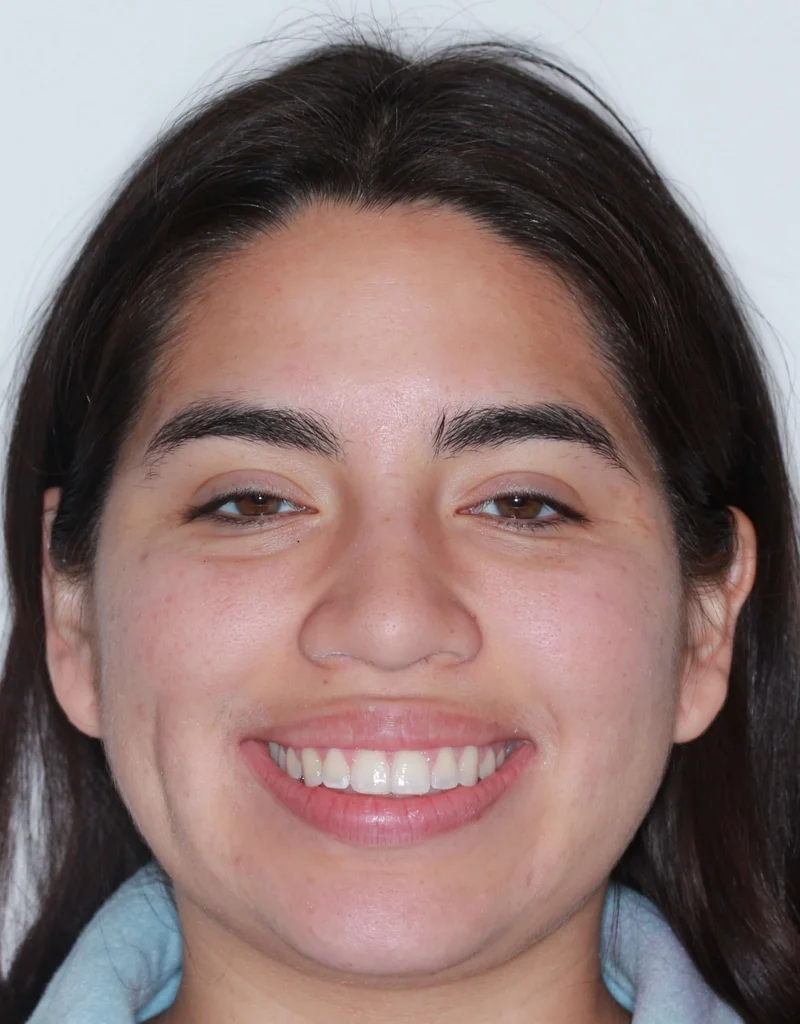 Smiling - After Treatment