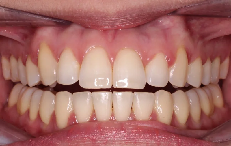 Center Open - After Treatment