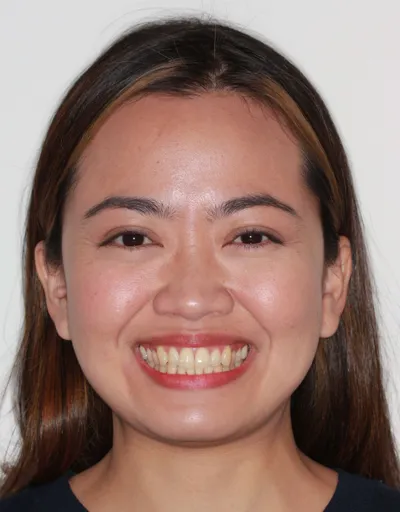 Before Clear Braces treatment - Case 54959