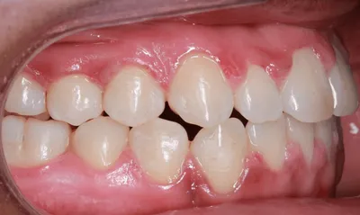 After Metal Braces treatment - Case 42721