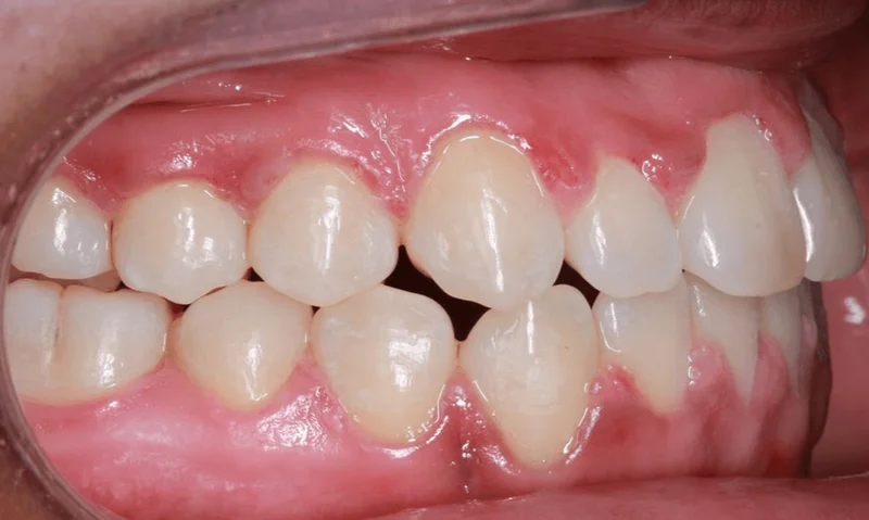 Right Buccal View - After Treatment