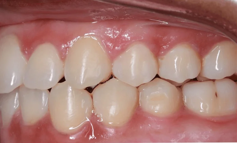 Left Buccal View - After Treatment