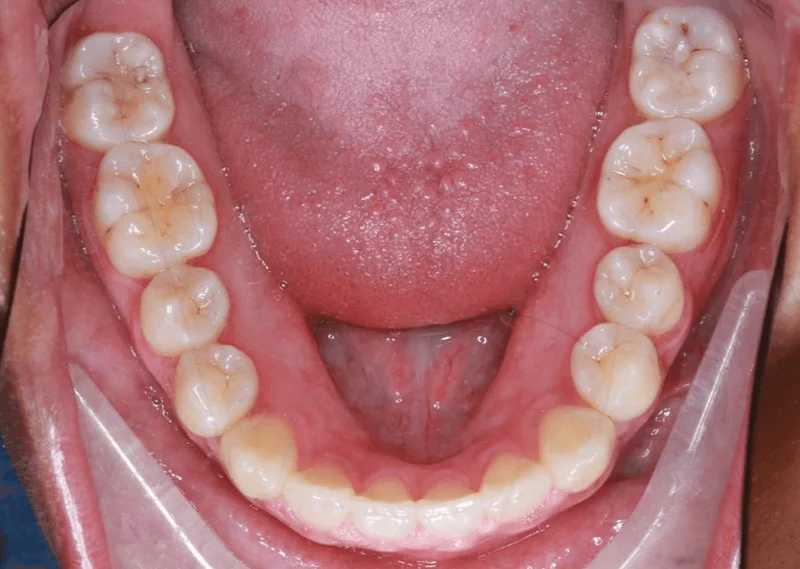 Lower Occlusal View - After Treatment