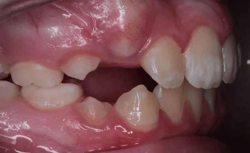 Right Side Bite - After Treatment