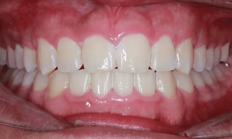 Center Bite - After Treatment