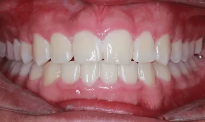 After Metal Braces treatment - Case 51928