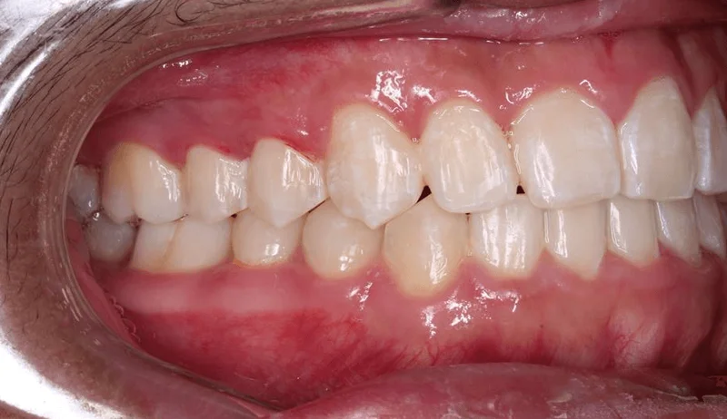 Buccal Right - After Treatment