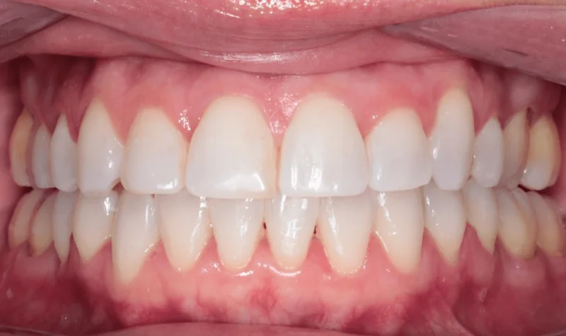 Center Bite - After Treatment
