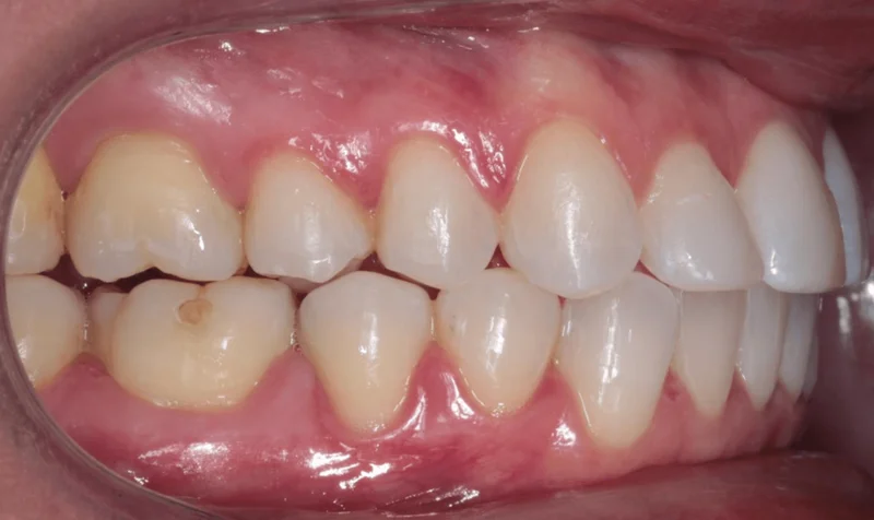 Right Side Bite - After Treatment