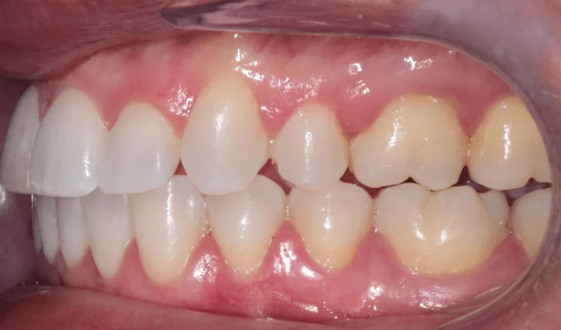 Left Side Bite - After Treatment