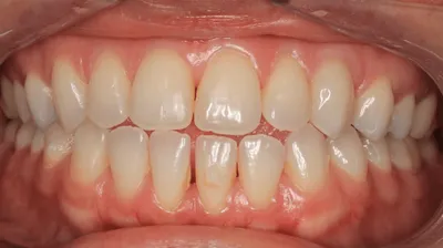 Before Invisible Braces treatment - Case 68764