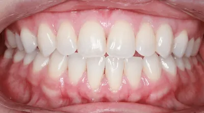After Invisible Braces treatment - Case 68764