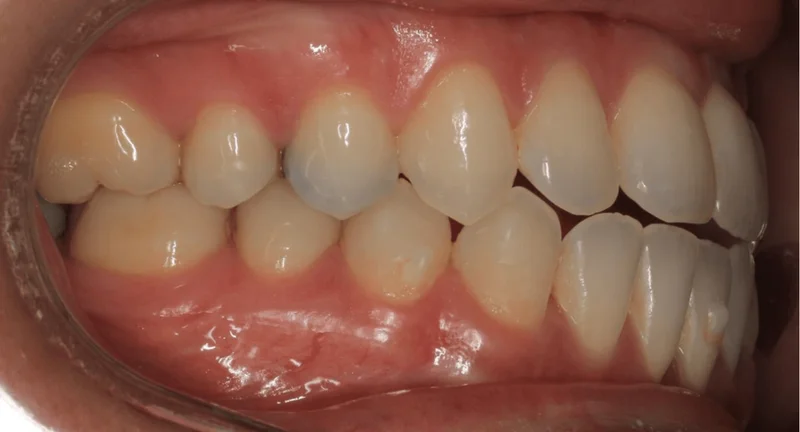 Right Side Bite - Before Treatment