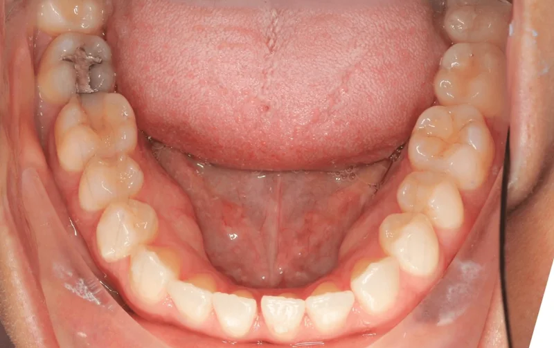 Lower Occlusal - Before Treatment