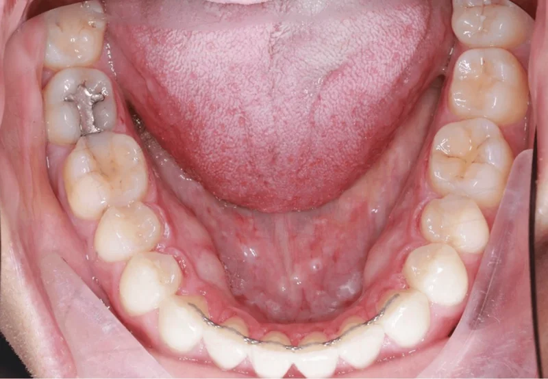 Lower Occlusal - After Treatment
