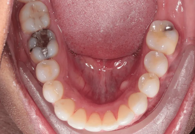Lower Occlusal View - After Treatment