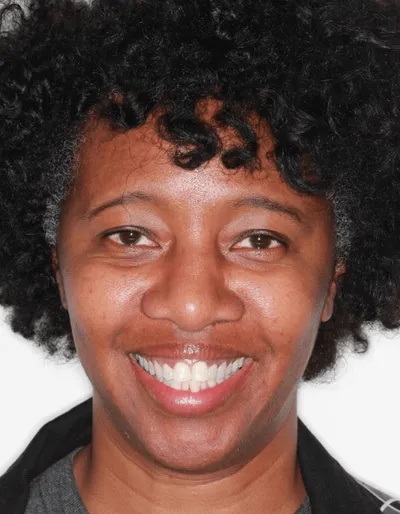 Before Metal Braces treatment - Case 53138