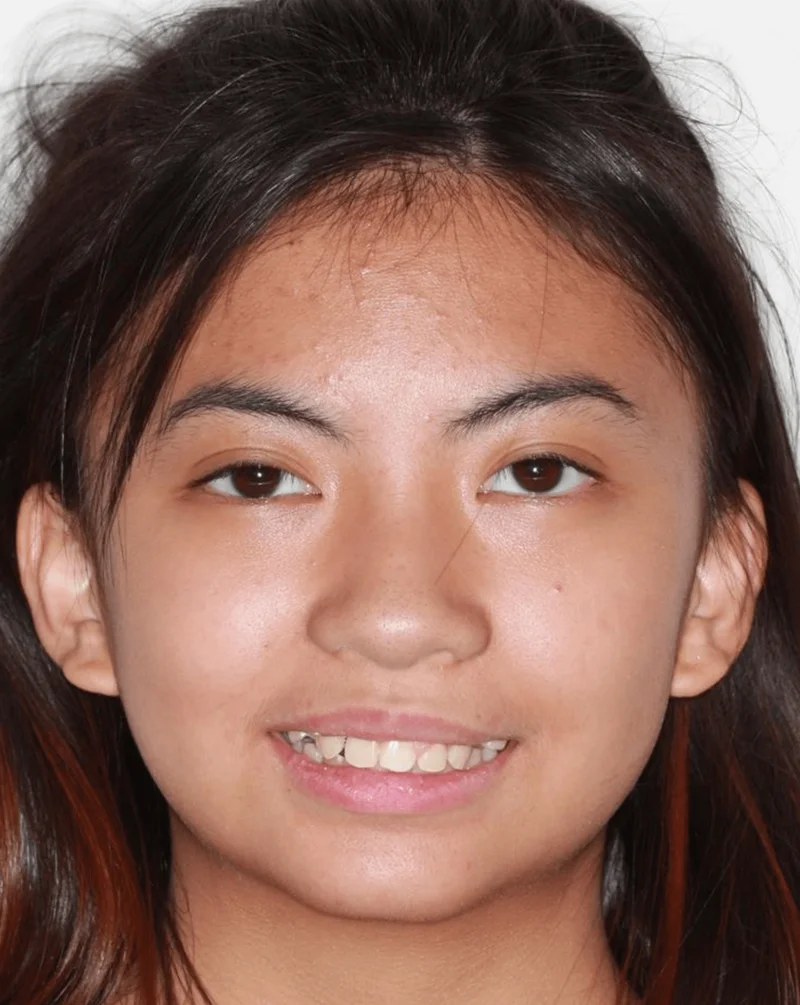 Smiling - Before Treatment