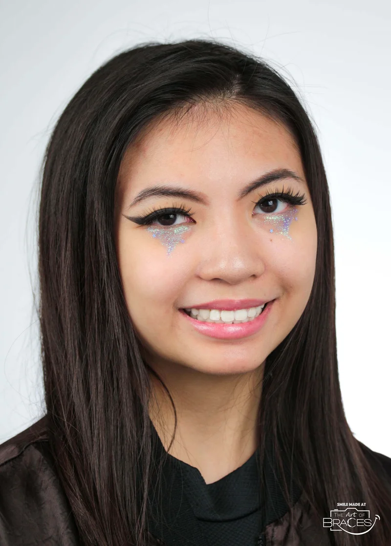 Smiling - After Treatment