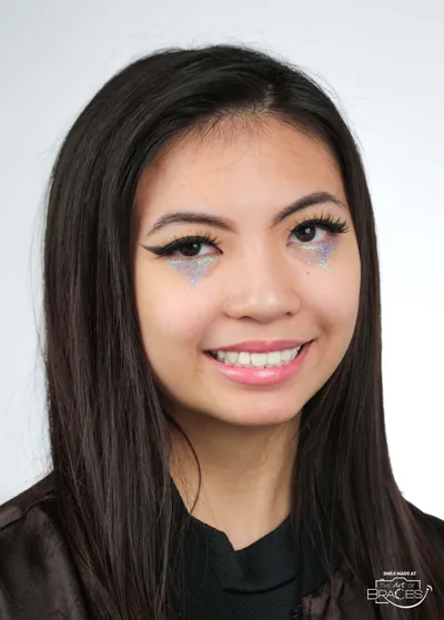 After Metal Braces treatment - Case 68774