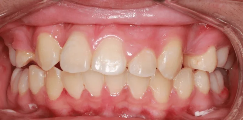 Center Bite - Before Treatment
