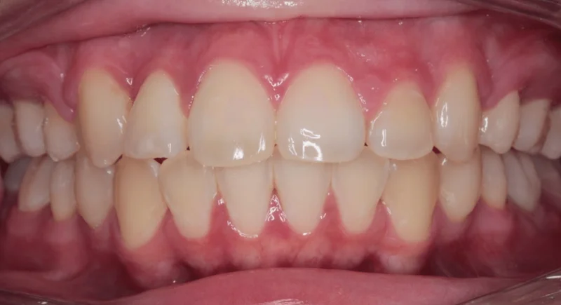 Center Bite - After Treatment