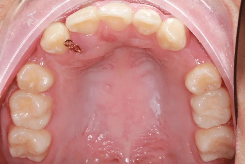 Upper Occlusal - Before Treatment