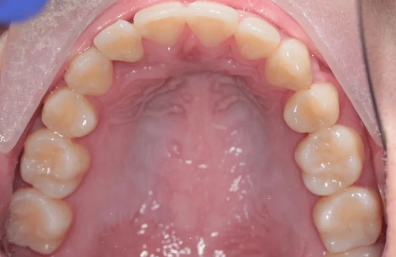 Upper Occlusal - After Treatment