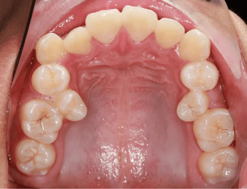 Occlusal Upper - Before Treatment