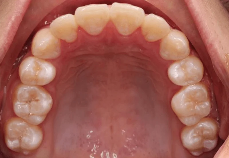 Occlusal Upper - After Treatment