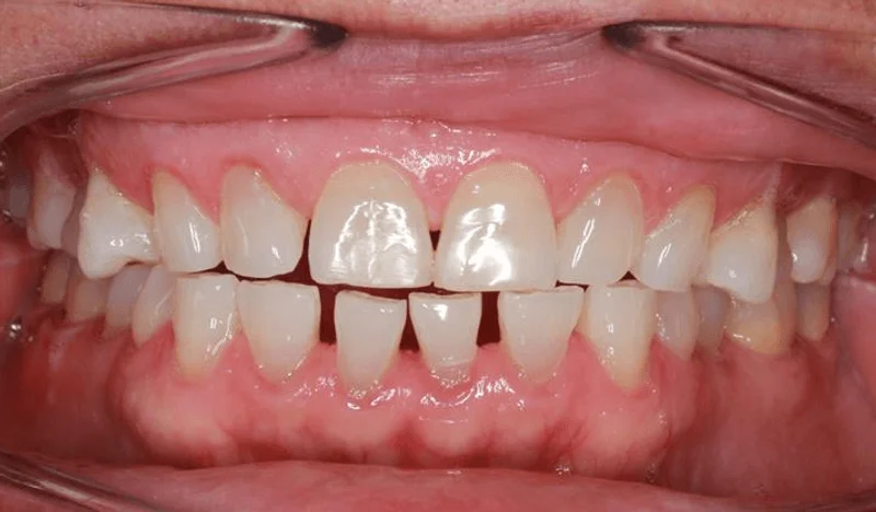 Center Bite - Before Treatment